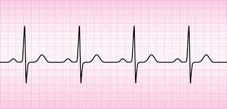 panic attack vs heart attack normal ECG